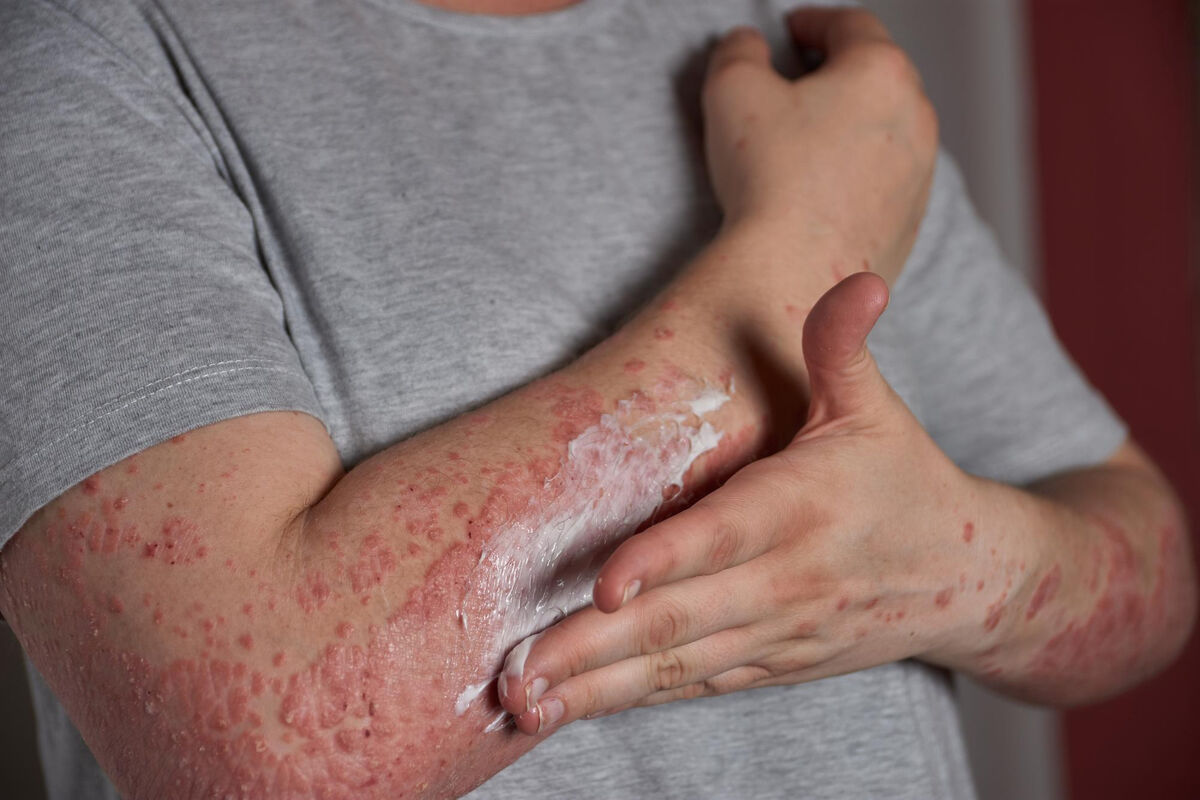 psoriaza ochorenie