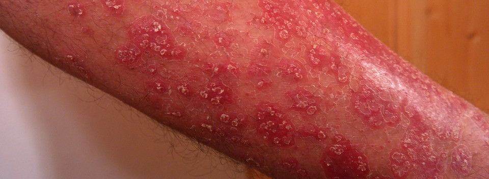 psoriaza liecenie
