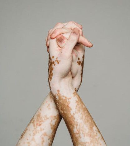 liecenie vitiligo