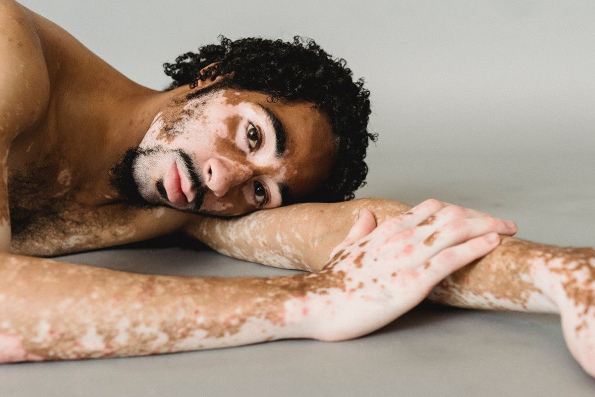 vitiligo ochorenie