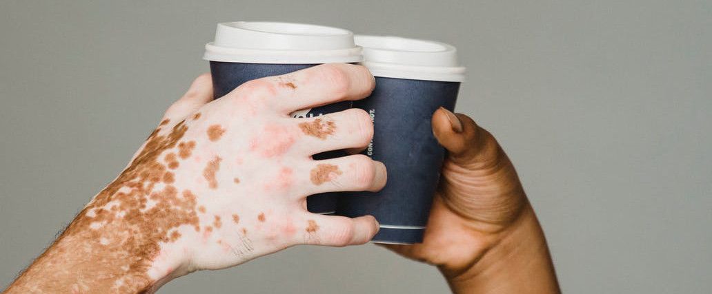 vitiligo priciny