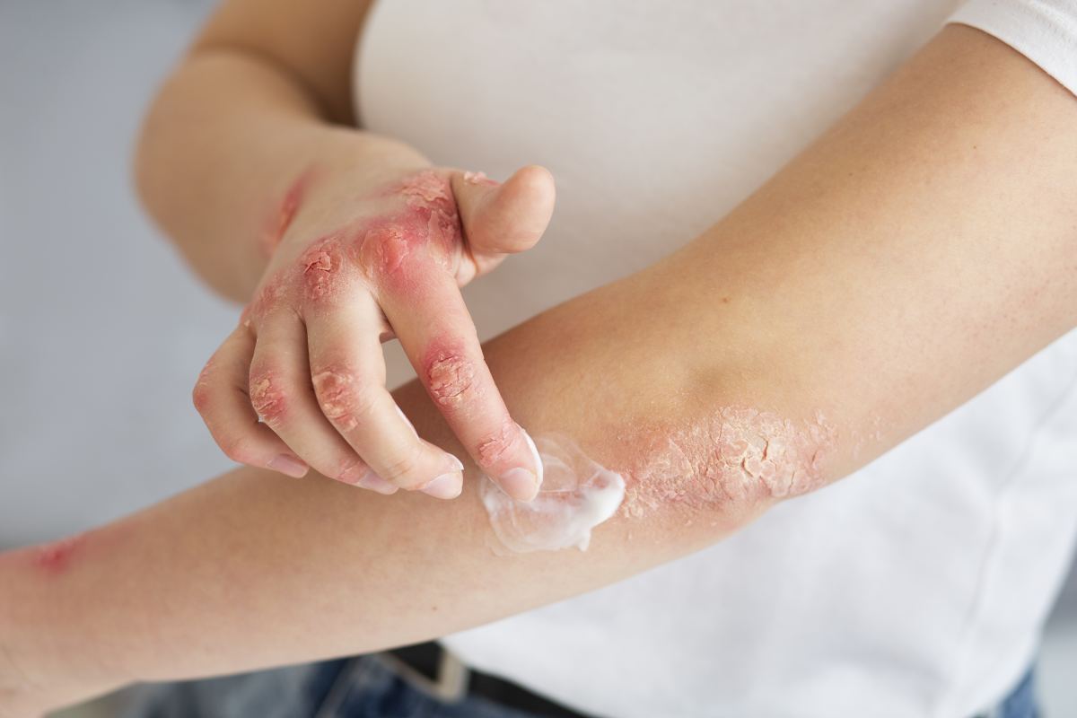 kozne ochorenie psoriaza ekzem liecba